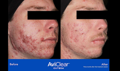 aviclear acne removal results before after mississauga oakville